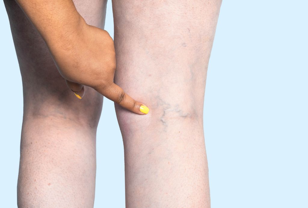 Chronic Venous Insufficiency: What You Need to Know
